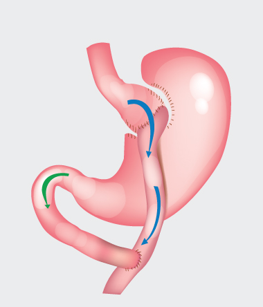 Le-bypass-gastrique